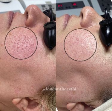 MICROCHANNELING Microchanneling treatments for face and hair loss
