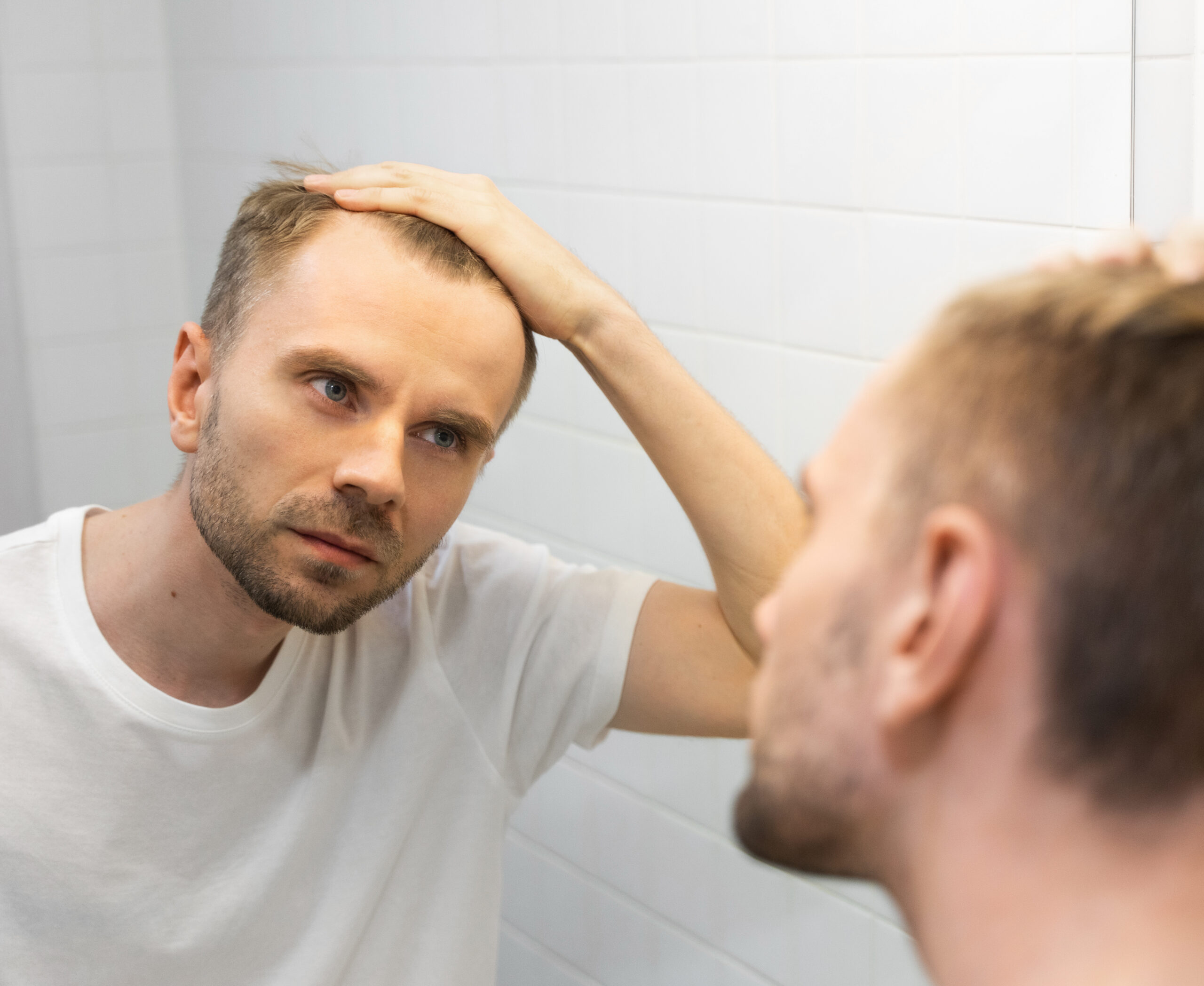 Male Hair loss