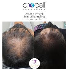 ProCell stimulates the growth of new follicles in the scalp and has shown to improve hair regrowth for both men and women.