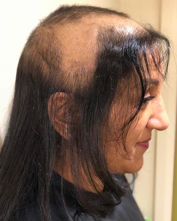 Bellevue Hair Loss Solutions