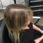 14_CNC_before Tacoma Hair Loss
